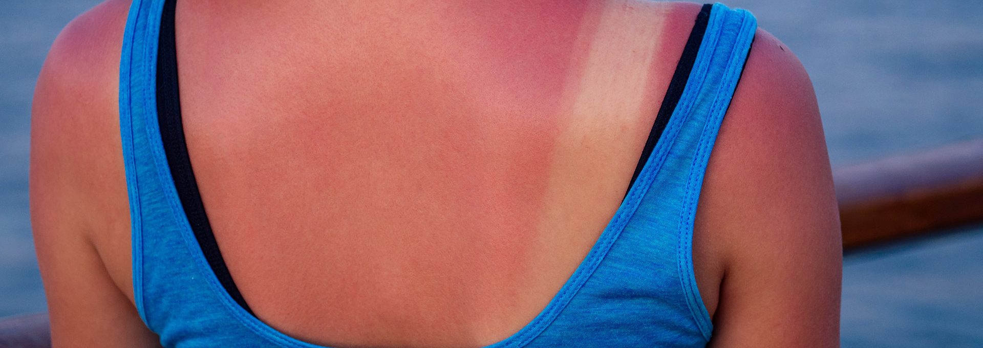 burnt-female-skin-sun-close-up-blue-t-shirt2